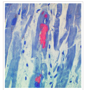 HHV-6 infection of cardiac myocytes, courtesy of Coppe Labs.