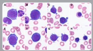 HHV-6 infection caused cytoplasmic extensions (A-D) and filamentous changes (E-H) in erythroblasts. Source: Blood, American Society of Hematology
